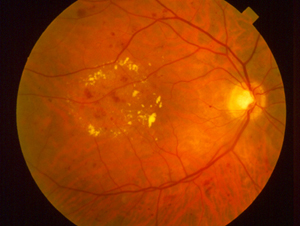 diabetic_retinopathy.jpg