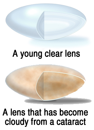 cataract.jpg