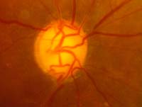 Chicago glaucoma - inside the eye