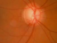 Chicago Eye Doctor - glaucoma