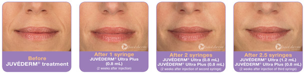 Juvederm in Chicago
