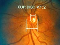 Chicago Eye Doctor - inner eye glaucoma