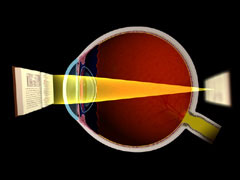 hyperopia